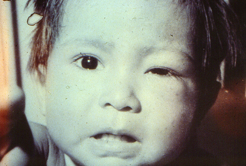 Fotografia em preto e branco mostra criança com inchaço ao redor do olho esquerdo.