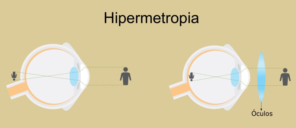 fata de ochelari hiperopie)