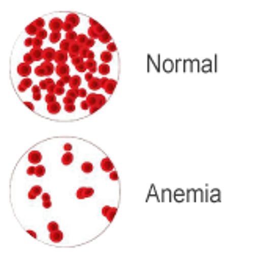 Anemia: principais tipos