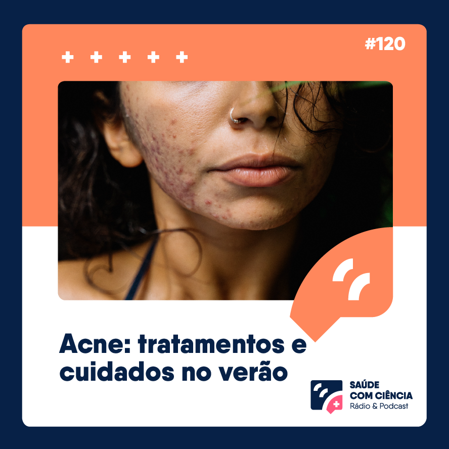 Acne: tratamentos e cuidados no verão